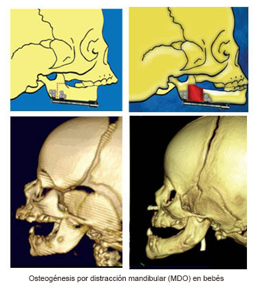 https://ultimatebabybox.store/SiteCollectionImages/Infant_Mandibular_Distraction_Osteogenesis_es.jpg