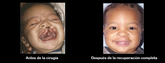 https://ultimatebabybox.store/SiteCollectionImagesArticleImages/CleftbeforeAfter_Baby_es.jpg
