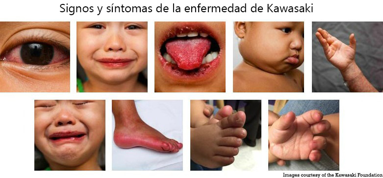 https://ultimatebabybox.store/SiteCollectionImagesArticleImages/Signs_Symptoms_Kawasaki_Disease_es.jpg