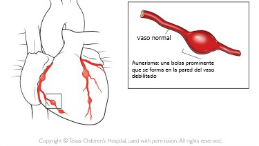 https://ultimatebabybox.store/SiteCollectionImagesArticleImages/aneurysm_texaschildrens_es.jpg