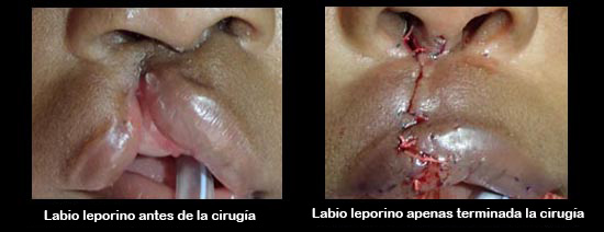 https://ultimatebabybox.store/SiteCollectionImagesArticleImages/cleftLipBeforeAfter2_es.jpg