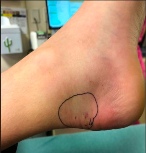 Two small puncture wounds about one-half inch apart (sometimes there may be only one fang mark)